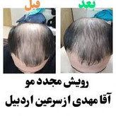 خرید عمده 10عددی تونیک رشد مو اصل تضمینی ۳۰۰ میل ارسال مستقیم از شرکت ایرانیان زمین