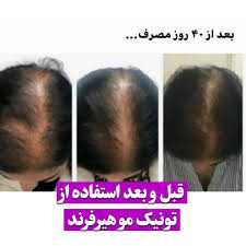 خرید عمده 10عددی تونیک کاهش ریزش مو و رشد مجدد مو اصل تضمینی ۳۰۰ میل ارسال مستقیم از شرکت ایرانیان زمین